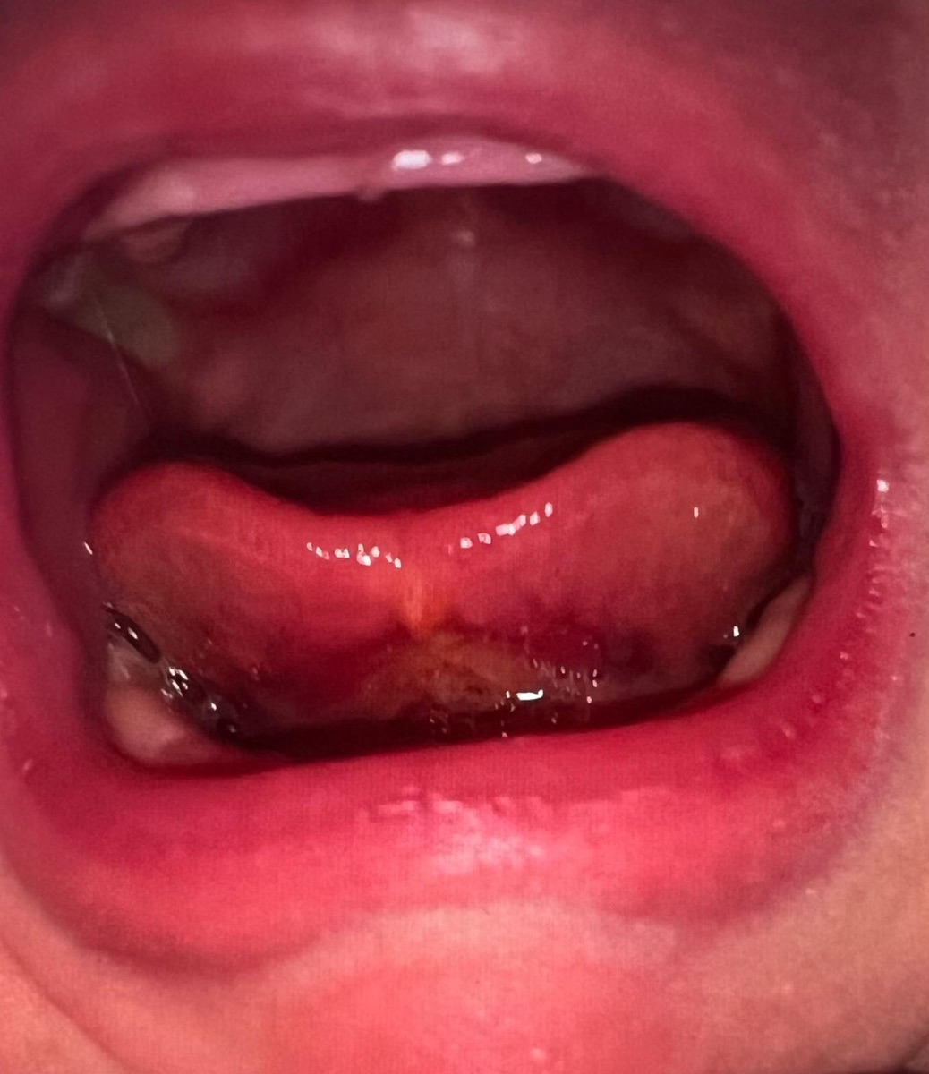 After division: close-up of the underside of an infant’s tongue